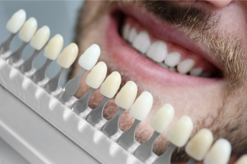 Cum să obții dinți albi și drepți? De ce să alegi fațete dentare?